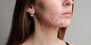 Acne: A Misunderstood Skin Disease and FDA-Approved Treatments - Stripped Beauty