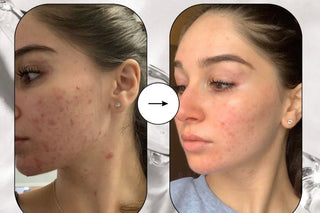Is It Time To Go On Medication for Your Acne? - Stripped Beauty